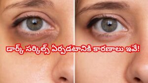 కళ్ల అందాన్ని తగ్గిస్తున్న డార్క్ సర్కిల్స్ – ఎందుకు వస్తాయంటే?