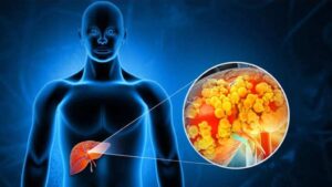 Fatty Liver: ఫ్యాటీలివర్ సమస్యతో బాధపడుతున్నారా..? మందులతో పని లేకుండా తగ్గించుకోండిలా..