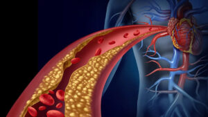 Cholesterol: కొలెస్ట్రాల్‌తో ప్రాణగండం.. ముందే పసిగట్టి జాగ్రత్త పడకుంటే గుండె జబ్బులతో అతలాకుతలం