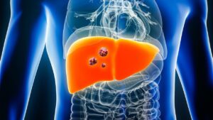 Liver Cancer : మీ డైట్ లో ఈ ‘కొవ్వు’ ఉంటే మీ లివర్ ప్రమాదంలో ఉన్నట్టే! చిన్న తప్పుతో లివర్ క్యాన్సర్ ముప్పు