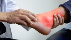 Uric Acid: ఈ చిన్న చిట్కాలతో.. యూరిక్ యాసిడ్ పరార్..