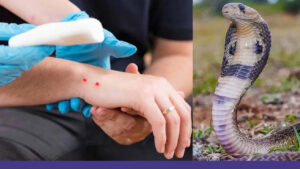 Snake Bite: పాము కాటేసిన వెంటనే ఏం చేయాలో తెలుసా..? ఈ తప్పులు చేస్తే ప్రాణాలకే రిస్క్..