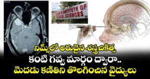 నిమ్స్⁭లో  అరుదైన శస్త్రచికిత్స.. కంటి గవ్వ మార్గం ద్వారా మెదడు కణితిని తొలగించిన వైద్యులు