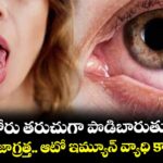 మీ కళ్లు, నోరు తరుచుగా పొడిబారుతున్నాయా?.. అయితే జాగ్రత్త.. ఆటో ఇమ్యూన్ వ్యాధి కావొచ్చు