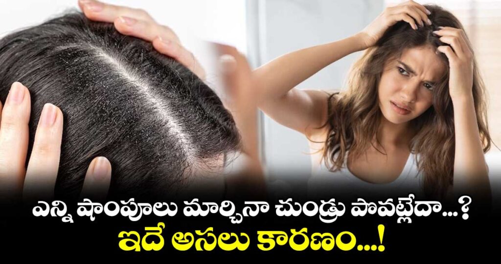 ఎన్ని షాంపూలు మార్చినా చుండ్రు పొవట్లేదా...? ఇదే అసలు కారణం...!